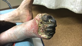 Frozen toes