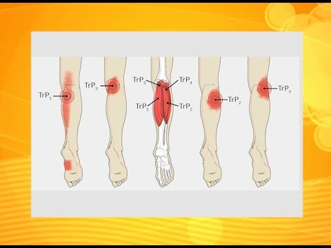 Video: Walang Simetriko Na Mga Tiklop Sa Mga Binti Ng Bata: Pamantayan O Paglihis