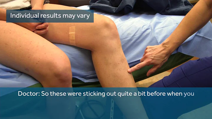 VenaSeal Varicose Vein Treatment - How It Works