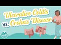 Ulcerative colitis vs crohns disease  know the difference  med surg help for nursing school