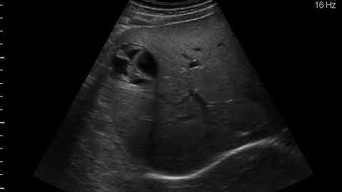 Cystic Echinococcus (CE3a)