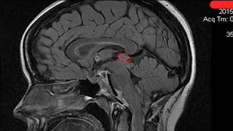 Plymouth woman battles rare brain condition