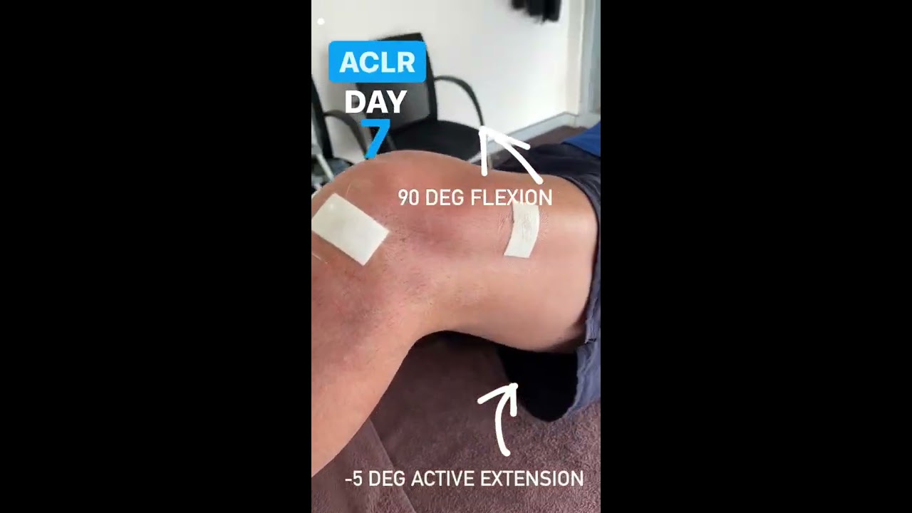 New ACL Surgery Patient In This Week Here Is His Active ROM At Day 7 Post Op 