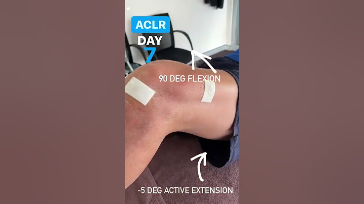 New ACL surgery patient in this week. Here is his active ROM at day 7 post-op.