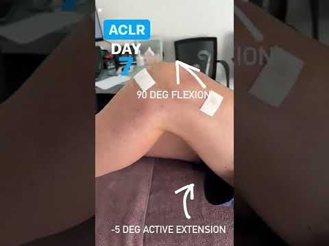 New ACL surgery patient in this week. Here is his active ROM at day 7 post-op.