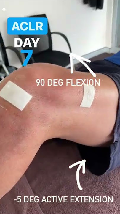 New ACL surgery patient in this week. Here is his active ROM at day 7 post-op.