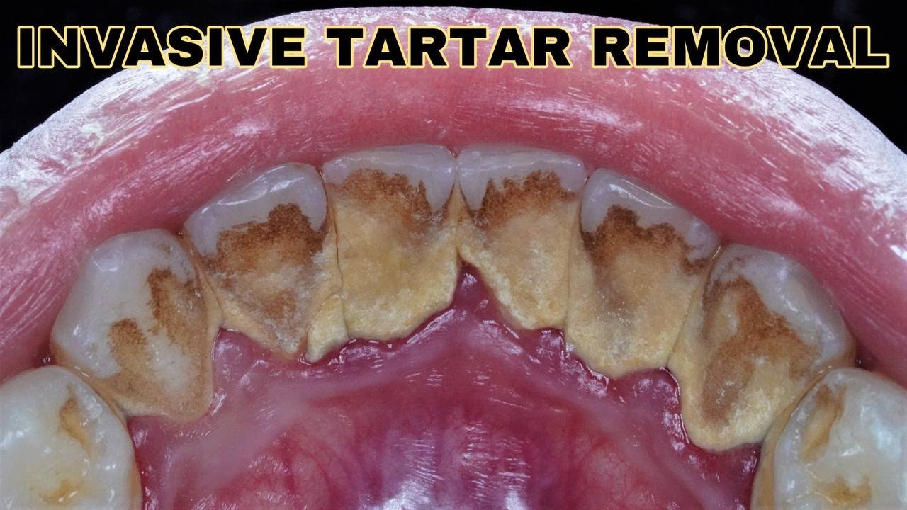 23 yo. Male's Teeth Teeth Cleaning Satisfying Dentist Dokter