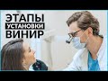 Этапы установки ВИНИРОВ. Как выглядят зубы после установки виниров?  | InSmile | Глеб Пекли