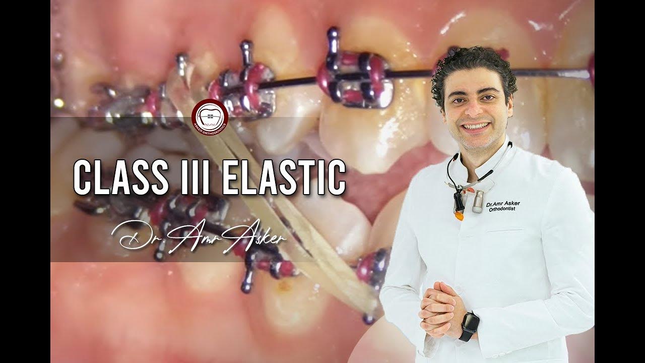 Orthodontic class III elastic step by step by Dr. Amr Asker rubber