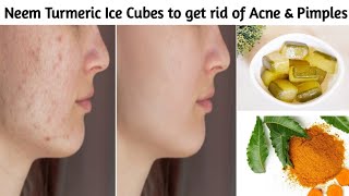 Neem Turmeric Ice Cubes to get rid of Acne, Pimples,Whiteheads, Blackheads &amp; Open Pores in 7 Days