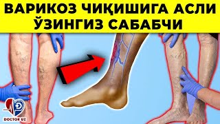 НИМА УЧУН ВАРИКОЗ КАСАЛЛИГИ КЎПРОҚ АЁЛЛАРДА УЧРАЙДИ? КЕЛИБ ЧИҚИШ САБАБИ ВА ДАВОСИ