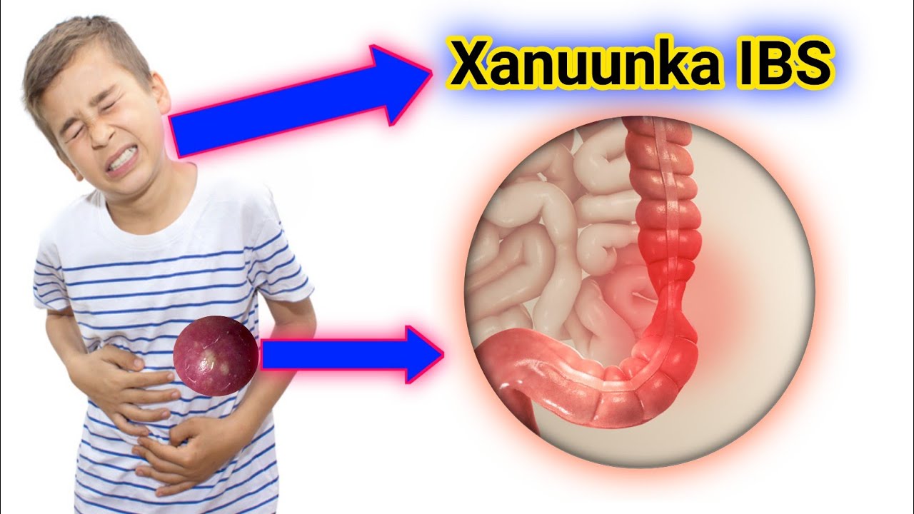 Xanuunka IBS ee lagu qaldo gaaska iyo sida loo kala saaro labada xanuun.......