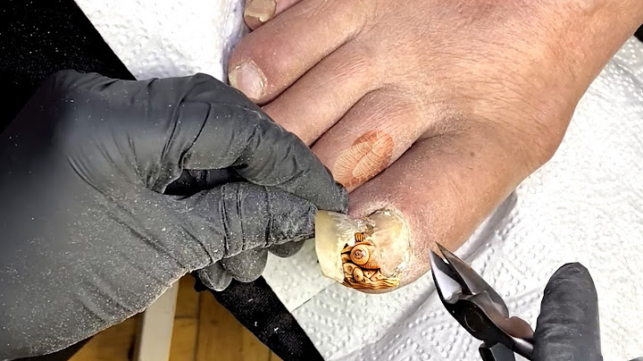 Who was Hiding under this Toenail - an unpleasant surprise
