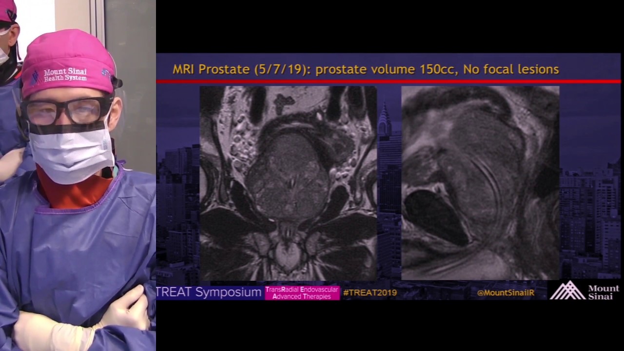 new york prostata mount sinai ct new york prostata mount sinai ct