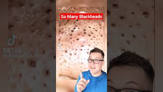 Most Blackheads I Have Ever Seen - BLACKHEAD REMOVAL #shorts