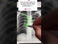 xray cvc tip location