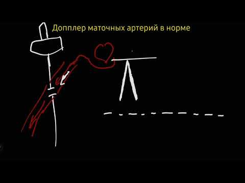 Допплер маточных артерий. Простая концепция