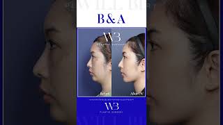 WILLBE 이중턱 지방흡입&amp;근육묶기 B&amp;A💎 #윌비성형외과 #김준영원장 #willbe #성형외과추천 #성형전후 #성형후기 #이중턱지방흡입 #이중턱근육묶기 #신사역성형외과