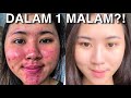 Hilangkan Bekas Jerawat Nanah dengan Cara Jitu