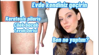 ÇİLEK BACAK/TAVUK DERİSİ-Nasıl geçer? Ben ne yaptım?