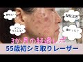 55歳母初ピコレーザーのシミ取り3ヶ月の経過