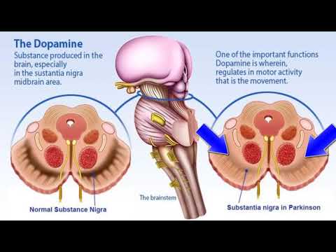 Vídeo: Alteración Del Metabolismo De La Dopamina En La Patogénesis De La Enfermedad De Parkinson