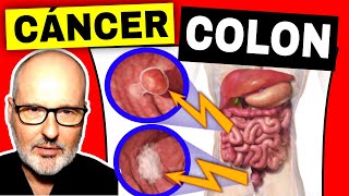 SÍNTOMAS PELIGROSOS de CÁNCER DE COLON (RECTO) Prevención y Tratamiento