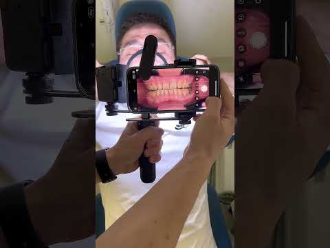 Mobile phone photography light for dental photos and videos. A must have tool for a dentist!