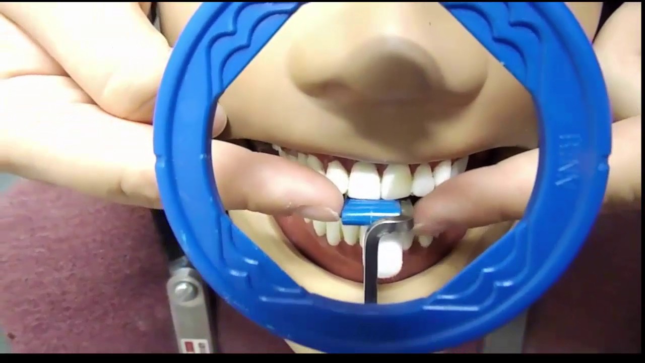 Maxillary Anterior Periapical Placement 7 27 16