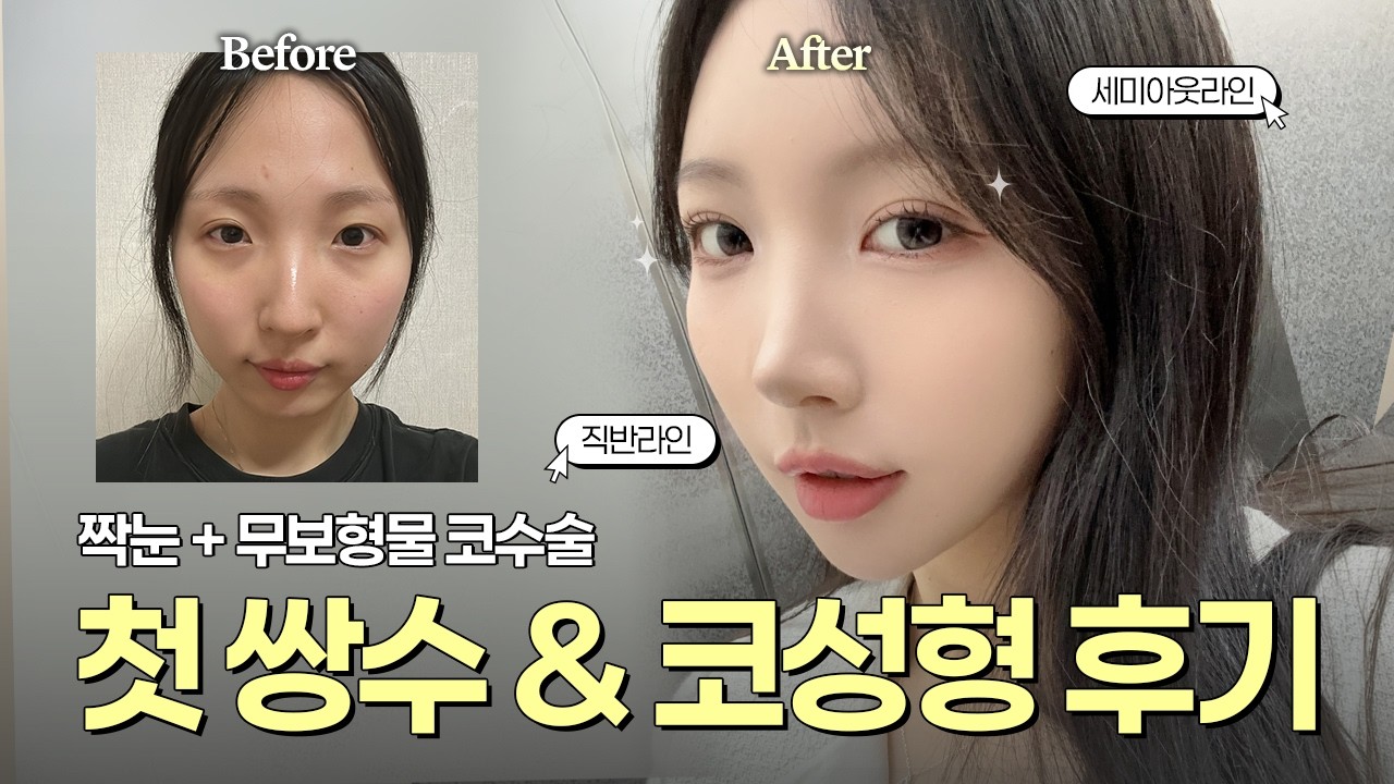 첫 눈코성형으로 추구미 도달🧡 | 세미아웃라인 쌍수 & 무보형물 코성형 2달 차 후기
