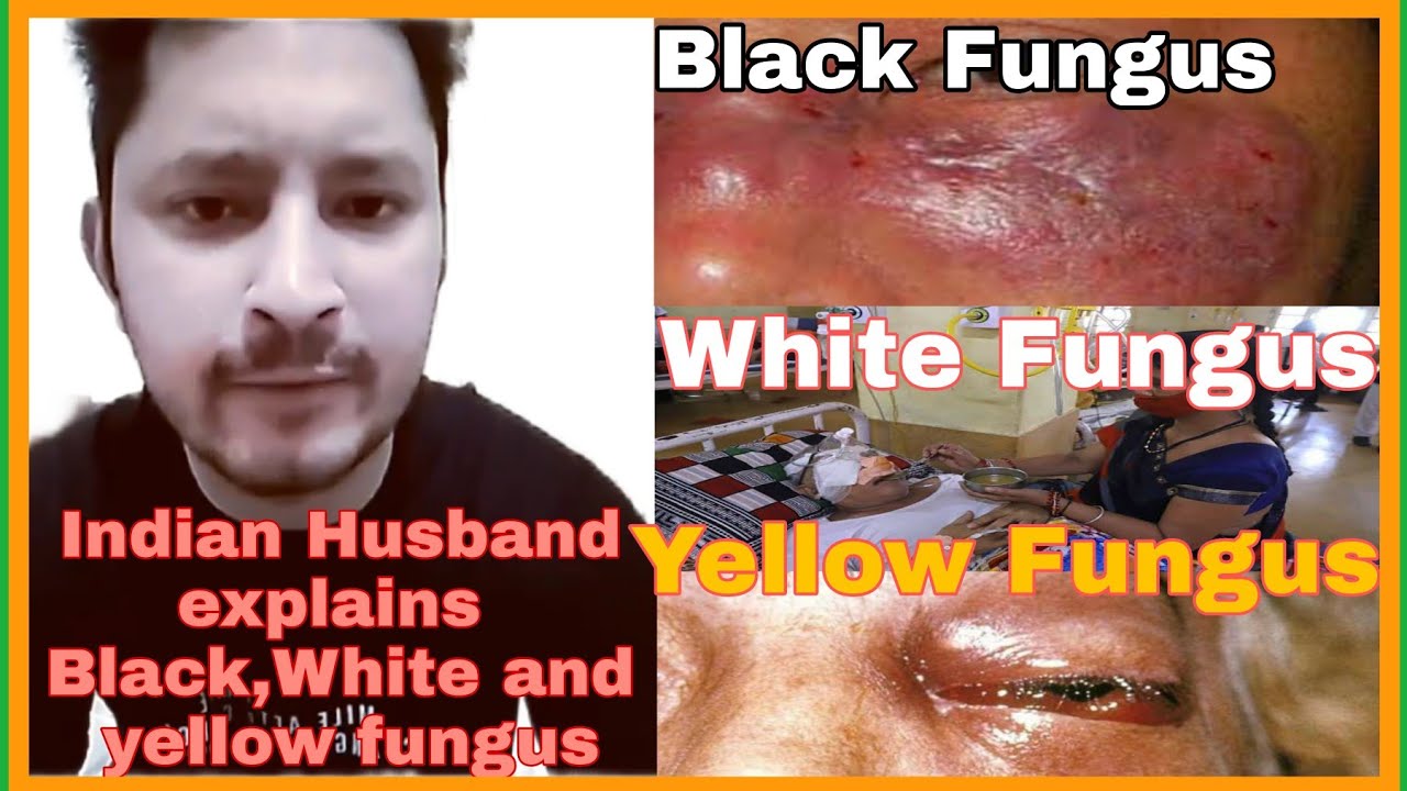 Epidemic in India+Indian Husband Explains Black,White and yellow fungus