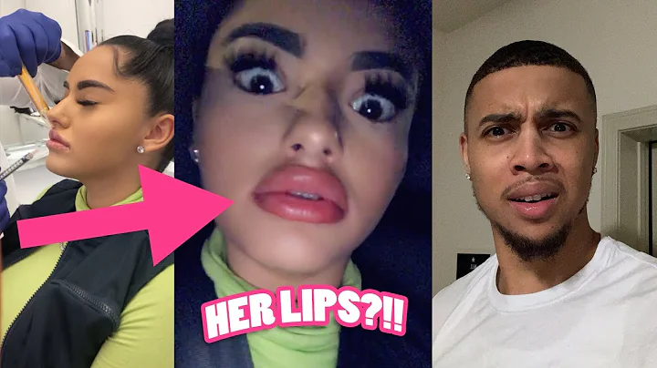 I GOT LIP INJECTIONS *BF REACTS*