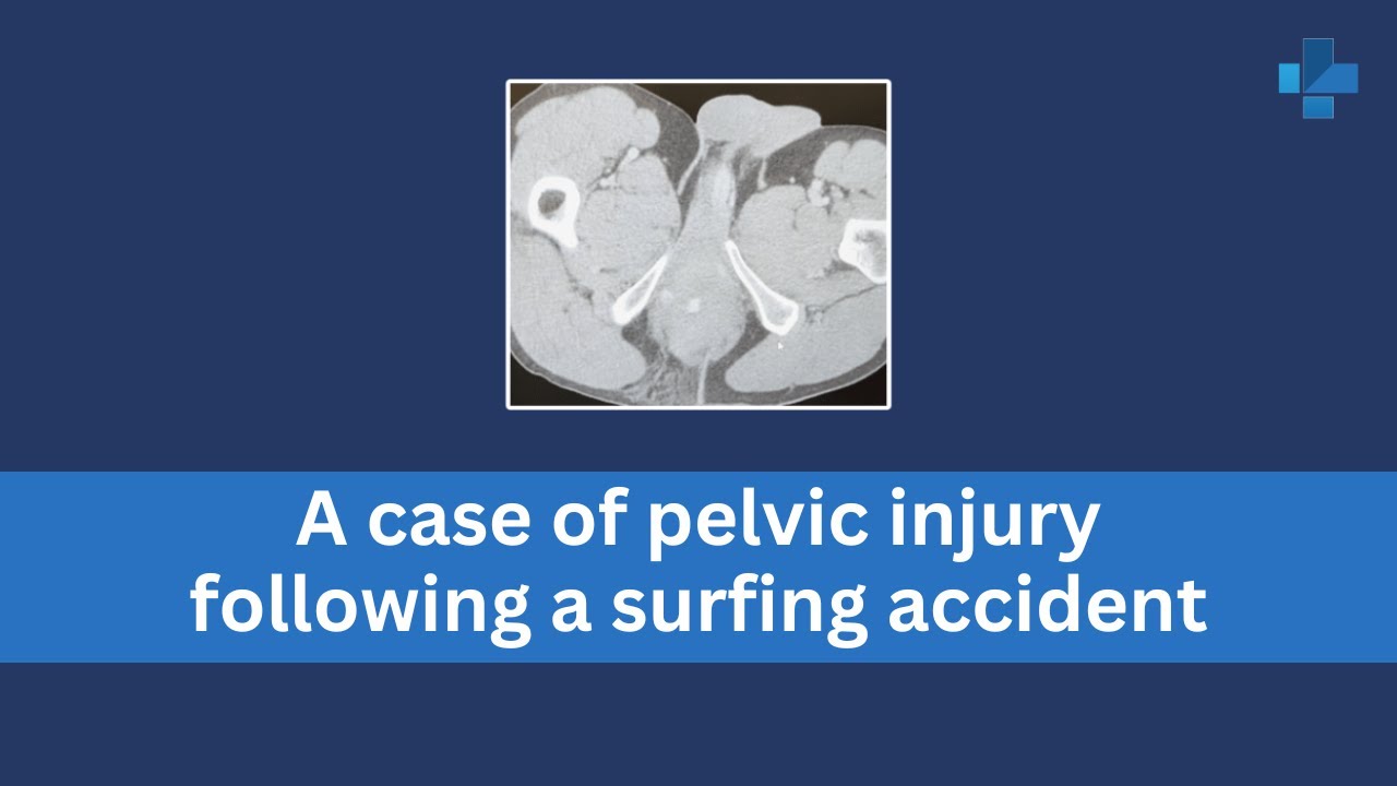 A case of pelvic injury following a surfing accident