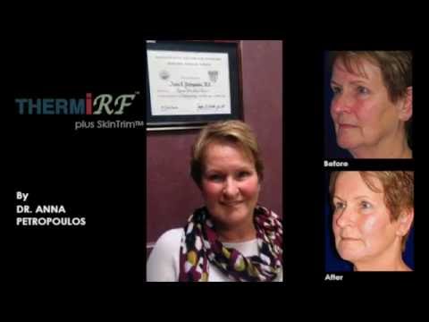 ThermiRF Patient Interview
