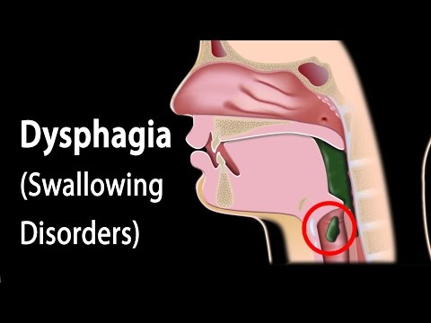 Videó: Dysphagia és GERD: Nyelési Nehézség Enyhítése