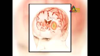 শিশুদের মস্তিষ্ক সংক্রান্ত নানা জটিলতা । পেডিয়াট্রিক নিউরোলজি | ডাঃ সারোয়ার জাহান