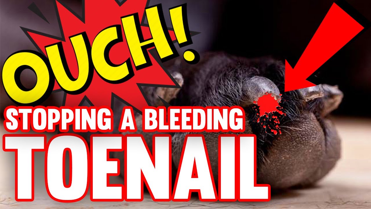 How To Stop A Bleeding Toenail!