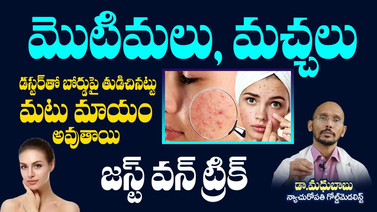 How To Get Rid Of PIMPLES OVERNIGHT | Acne Treatment | HItv Health | Dr ...
