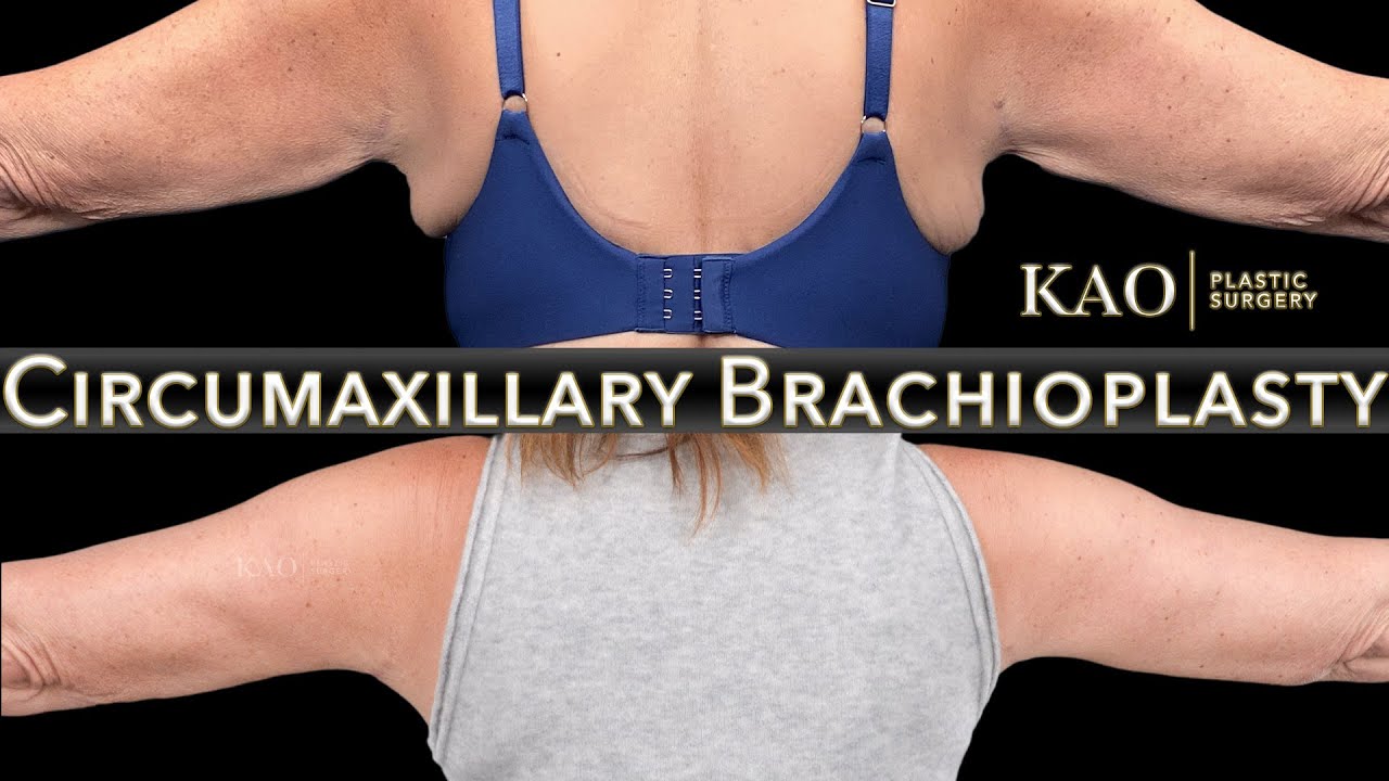 Kao Plastic Surgery Arm Lift Without The Huge Scars Circumaxillary