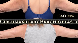 KAO Plastic Surgery Arm Lift Without The Huge Scars  Circumaxillary Brachioplasty  Arm Tightening