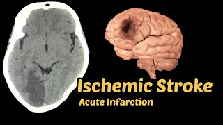 Ischemic Stoke : Acute Infarction Ct Brain | Radiology