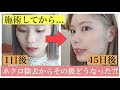 【ホクロ除去】その後どうなった?!1日後、9日後、45日後の経過報告!