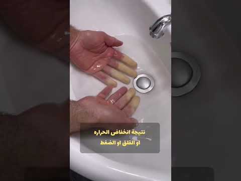 اطراف الاصابع تتحول الى اللون الابيض السبب والحل متلازمة رينود  