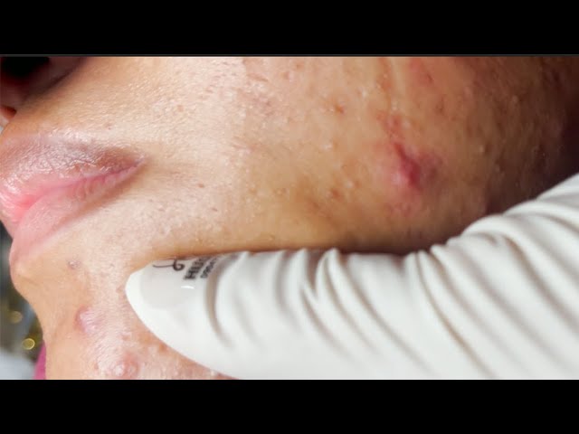 Make your Acne Treatment Huong Da Nang#509 | acne 2022
