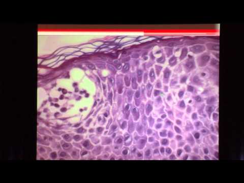 Video: Cov Tawv Nqaij O Tawv (Vesiculopustular Dermatoses) Hauv Miv