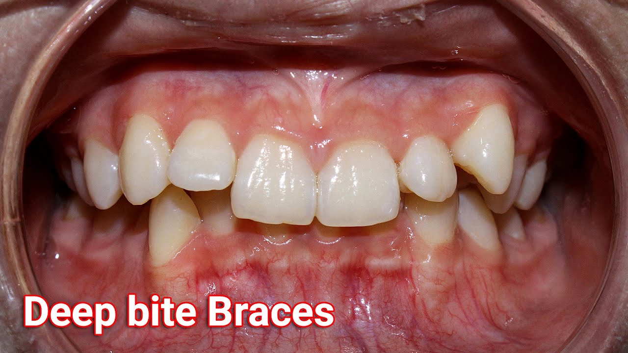 26Month Braces Journey YouTube