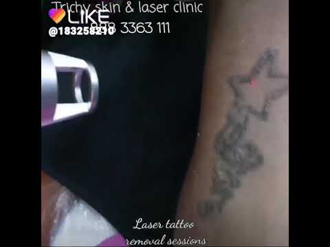 Laser tattoo removal