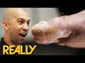 Jonathan Tomines Removes "Extremely Thickened & Damaged" Toenails | Toe Bro