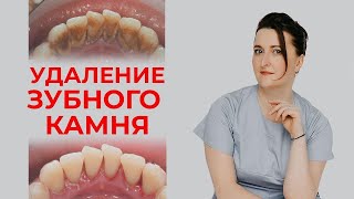 Как удалить зубной камень? / Профессиональная гигиена полости рта