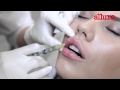 Техника увеличения губ филлерами: видео из операционной